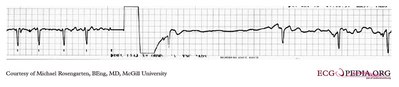 Atrieflimmer EKG
